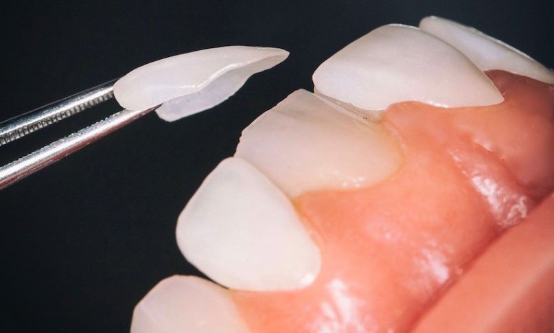 veneers1