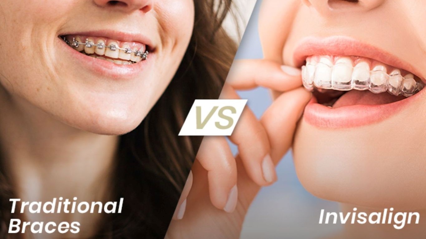 Invisalign vs. Braces: The Ultimate Smile Showdown!