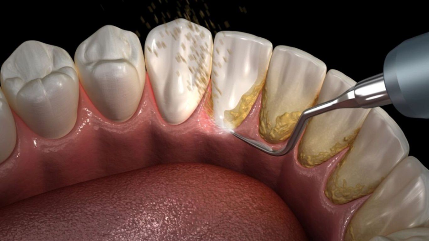 Does Scaling Weaken Your Teeth?