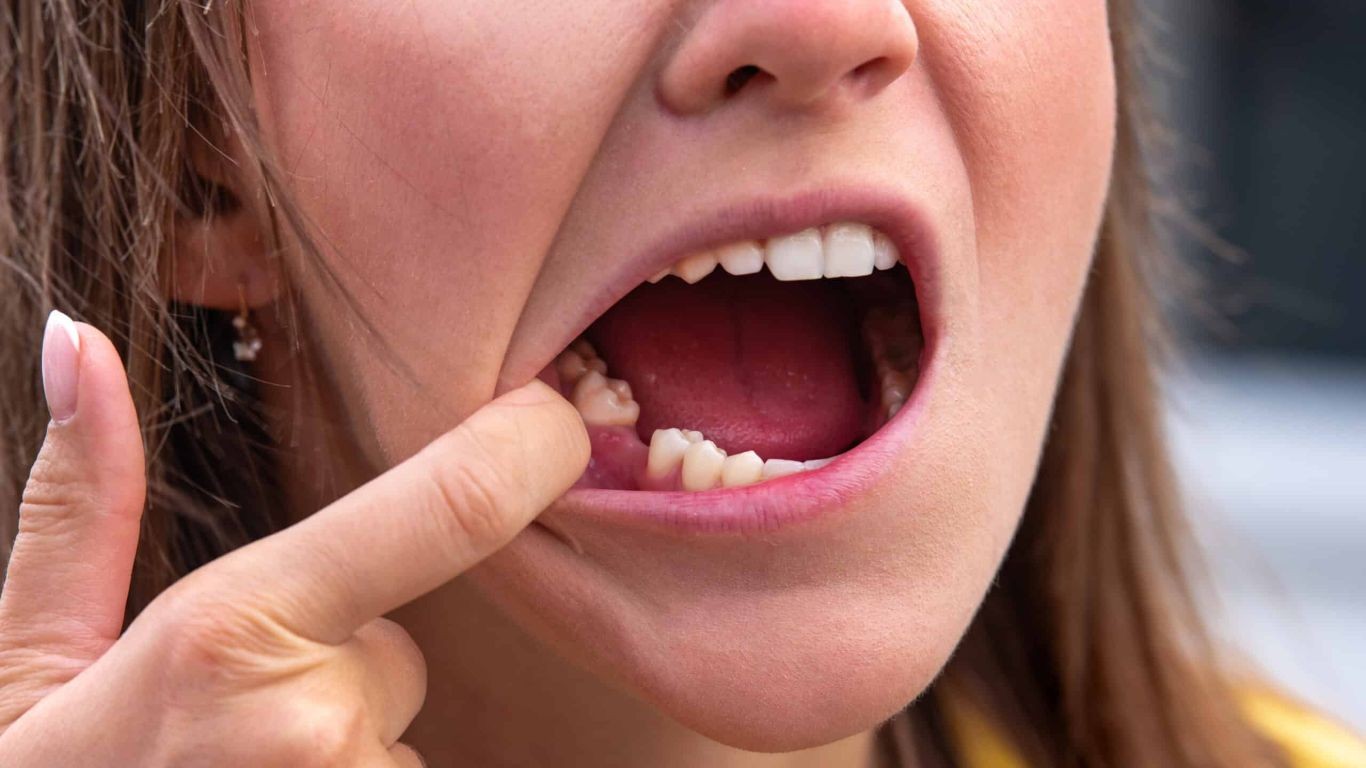 The Hidden Cost of Delaying a Missing Tooth Replacement
